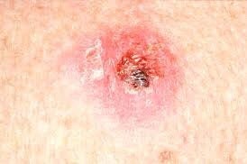 Jamaican Psoriasis | Eczema Actinic Keratosis | Prone Skin Moisturizer Oil - 8oz
